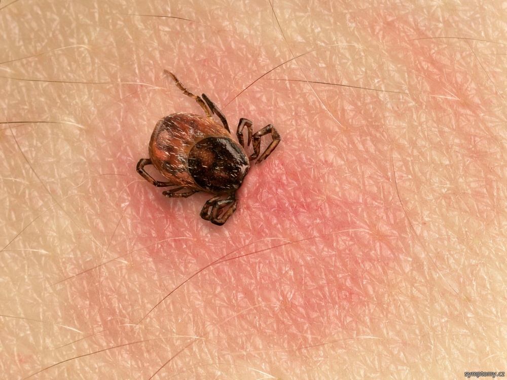 Aktivita klíšťat je letos nadprůměrná, varuje ministerstvo